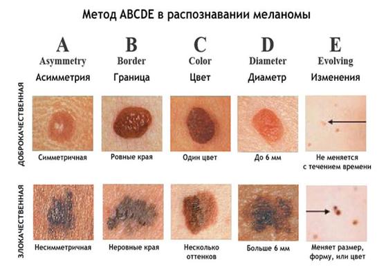 Рак кожи